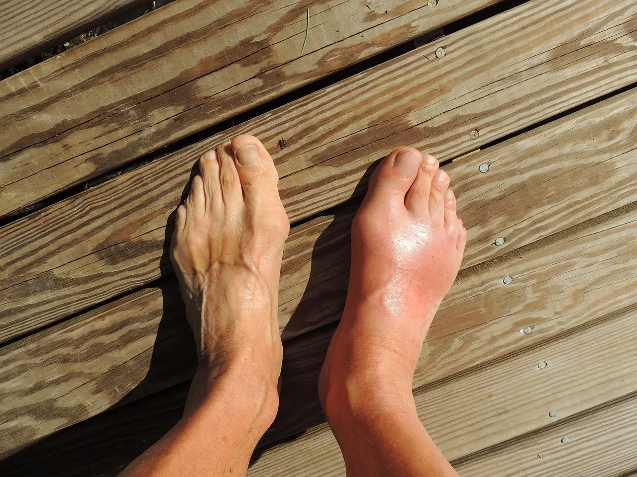 feet, gout, pain, natural treatments for gout attacks