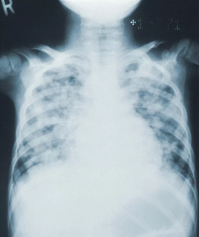 person in black and white plaid shirt, pneumonia symptoms