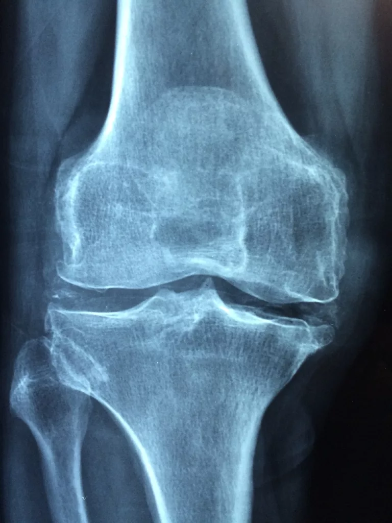 knee, old, care, osteoporosis