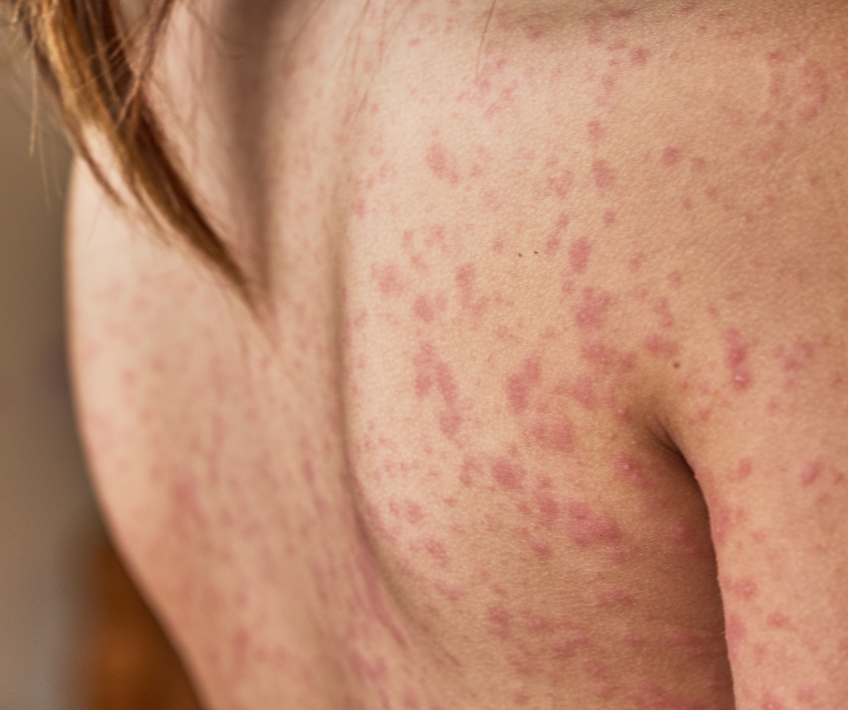 Home Remedies for Allergies: Natural Tips for Managing Allergy Symptoms 1 Home Remedies for Allergies