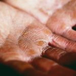 dehydration symptoms